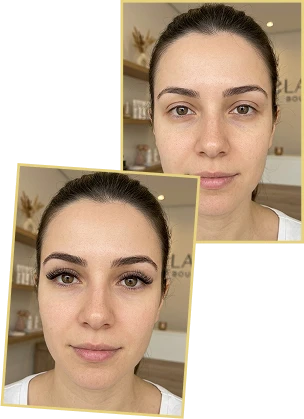 Resultado de antes e depois