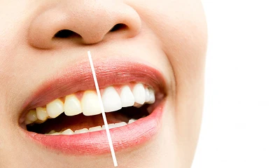 Restauração Estética